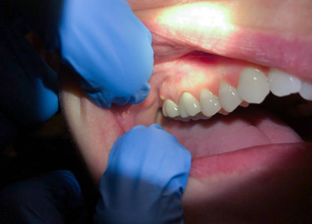 Best Emergency Treatment for Oral Infections in Comanche, OK